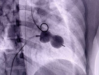 Assam : Narayana  Hospital Successfully operates on a valve disease in a non-surgical way