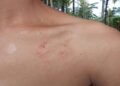 Beaten Black & Blue: Parents Say School Hit Son, Then Blocked Exams