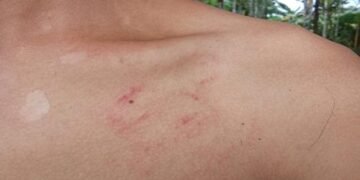 Beaten Black & Blue: Parents Say School Hit Son, Then Blocked Exams
