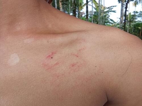 Beaten Black & Blue: Parents Say School Hit Son, Then Blocked Exams