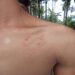 Beaten Black & Blue: Parents Say School Hit Son, Then Blocked Exams